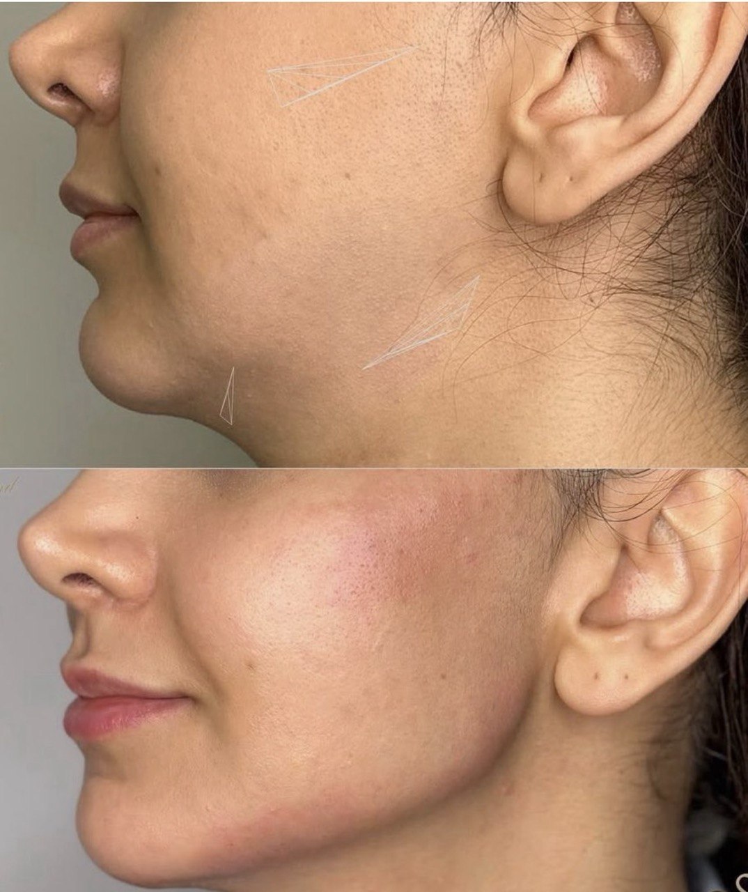 Before and after facial rejuvenation result