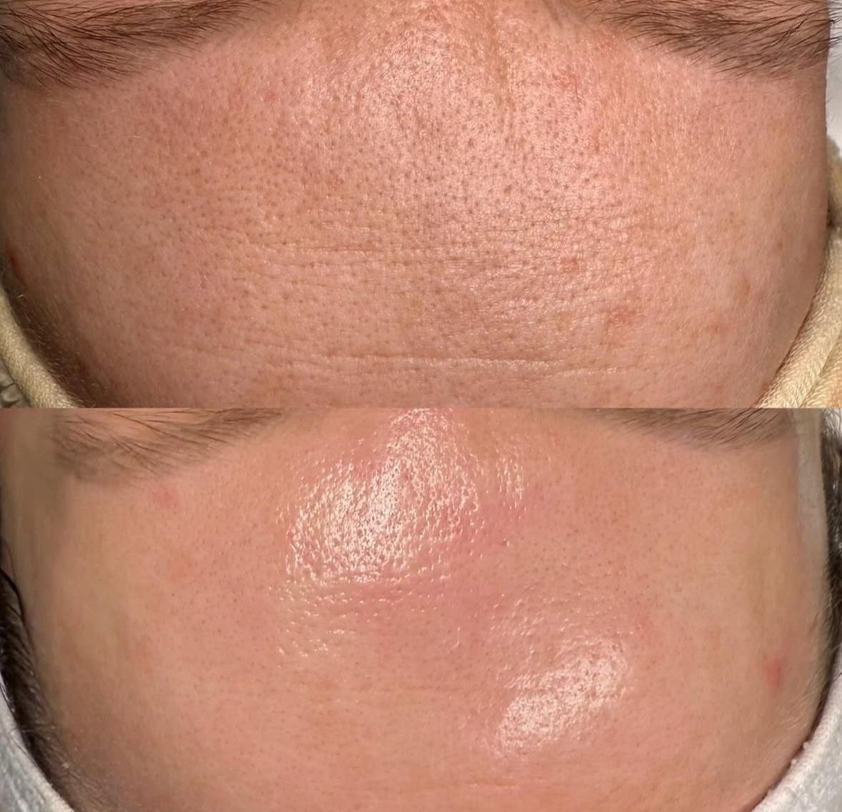 Before and after forehead smoothing result