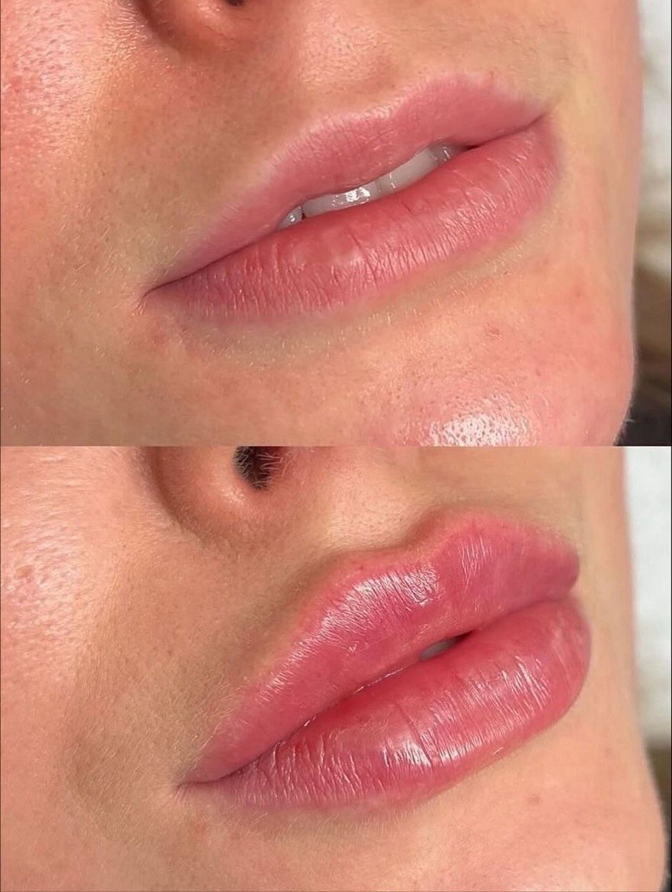 Before and after lip enhancement result