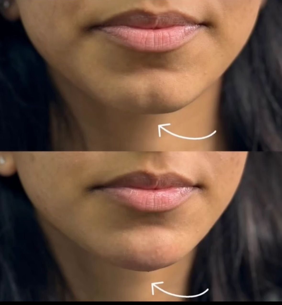 Before and after lower face balancing result